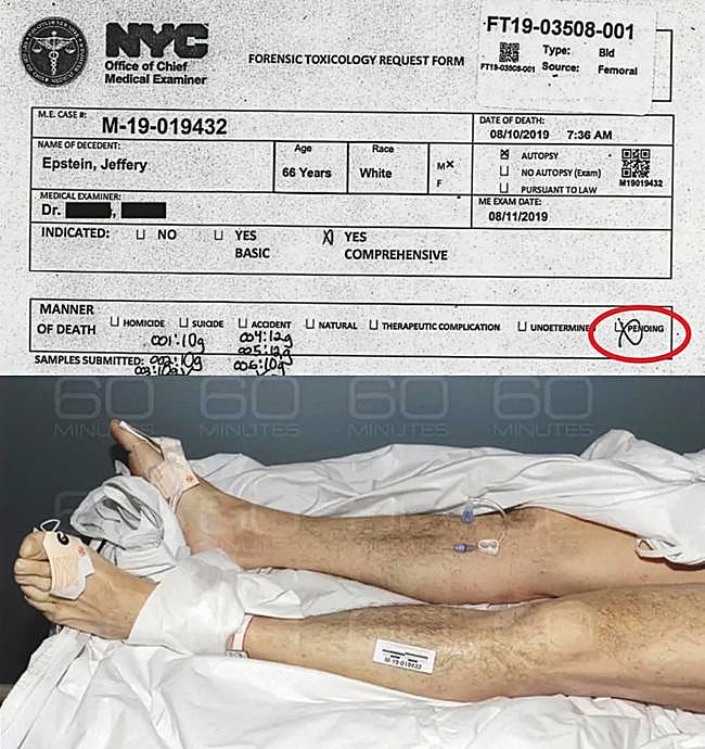 La autopsia de Jeffrey Epstein, de 66 años, registra la forma de su muerte como «pendiente», según se puede comprobar en los últimos documentos publicados por el Departamento de Justicia. Abajo: una de las imágenes del cadáver que se incluyen en el informe de la autopsia y que ya emitió el programa 60 minutos, de la cadena CBS, en 2020