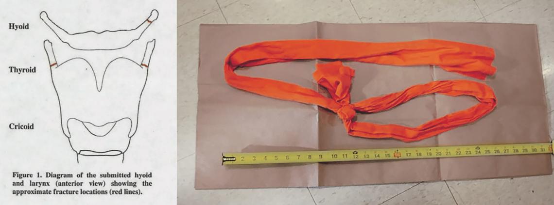 La autopsia revela fracturas en tres lugares del cuello, algo inusual en los suicidios. Este trozo de sábana atado hallado en la celda no encaja con la lesión en el cuello. La soga que habría usado Epstein nunca ha sido identificada con certeza.