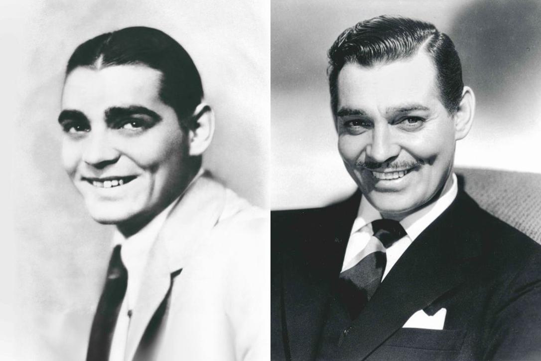 Clark Gable se realizó una otoplastia para corregir sus orejas y tuvo que usar dentaduras postizas com-pletas desde los 32 años (con desastrosas consecuencias de halitosis).