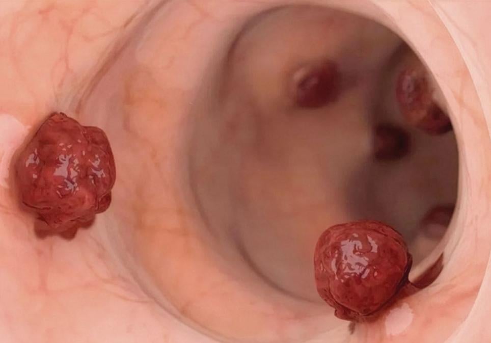 El cáncer de colon y recto es el tumor más frecuente en España: 45.000 nuevos casos en 2025. Es el segundo en hombres, por detrás del de próstata, y el segundo en mujeres, tras el de mama. La buena noticia: se muere cada vez menos de él. Entre 2004 y 2022 la mortalidad cayó casi un 20 por ciento. Los programas de cribado han sido y son claves.