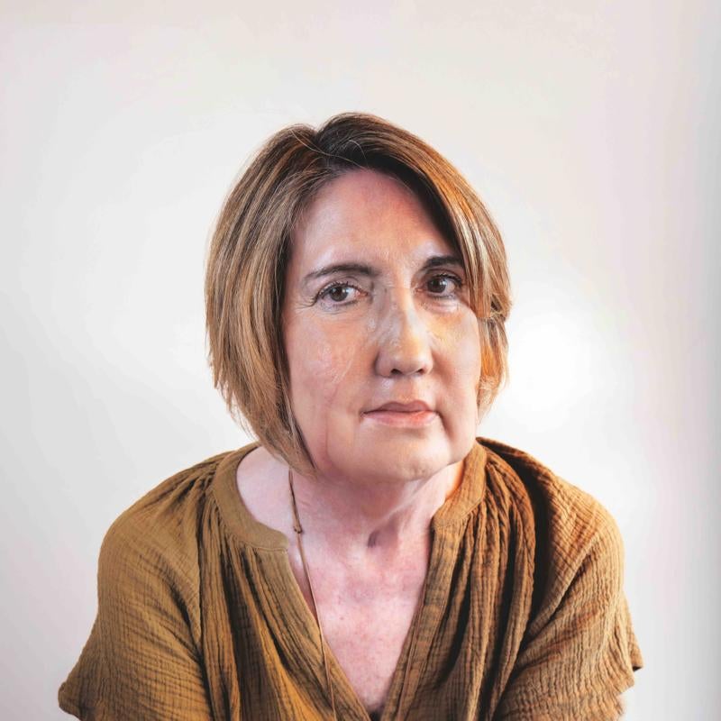 Carmen Gil, primera mujer en recibir un trasplante de cara de una donante a la que se le practicó una eutanasia