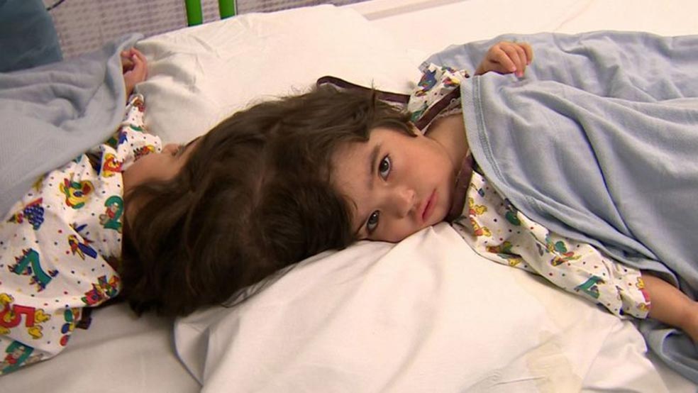Safa y Marwa son otras dos hermanas siamesas, nacidas en Pakistán en 2017, separadas en una operación pionera, fruto de una combinación entre las habilidades de los médicos y la innovación tecnológica. Antes de la cirugía daban por hecho que solo podrían salvar a una de las niñas. Finalmente consiguieron que las dos puedan vivir hoy autónomamente.