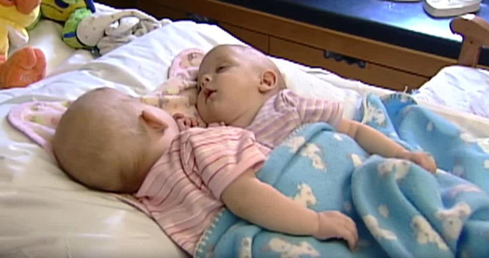 Isabelle y Abigail Carlsen compartían los órganos de su cavidad abdominal y estaban también unidas a nivel cardiovascular. La exitosa intervención que las separó en 2006 marcó un antes y un después en la perspectiva de los nacidos siameses.