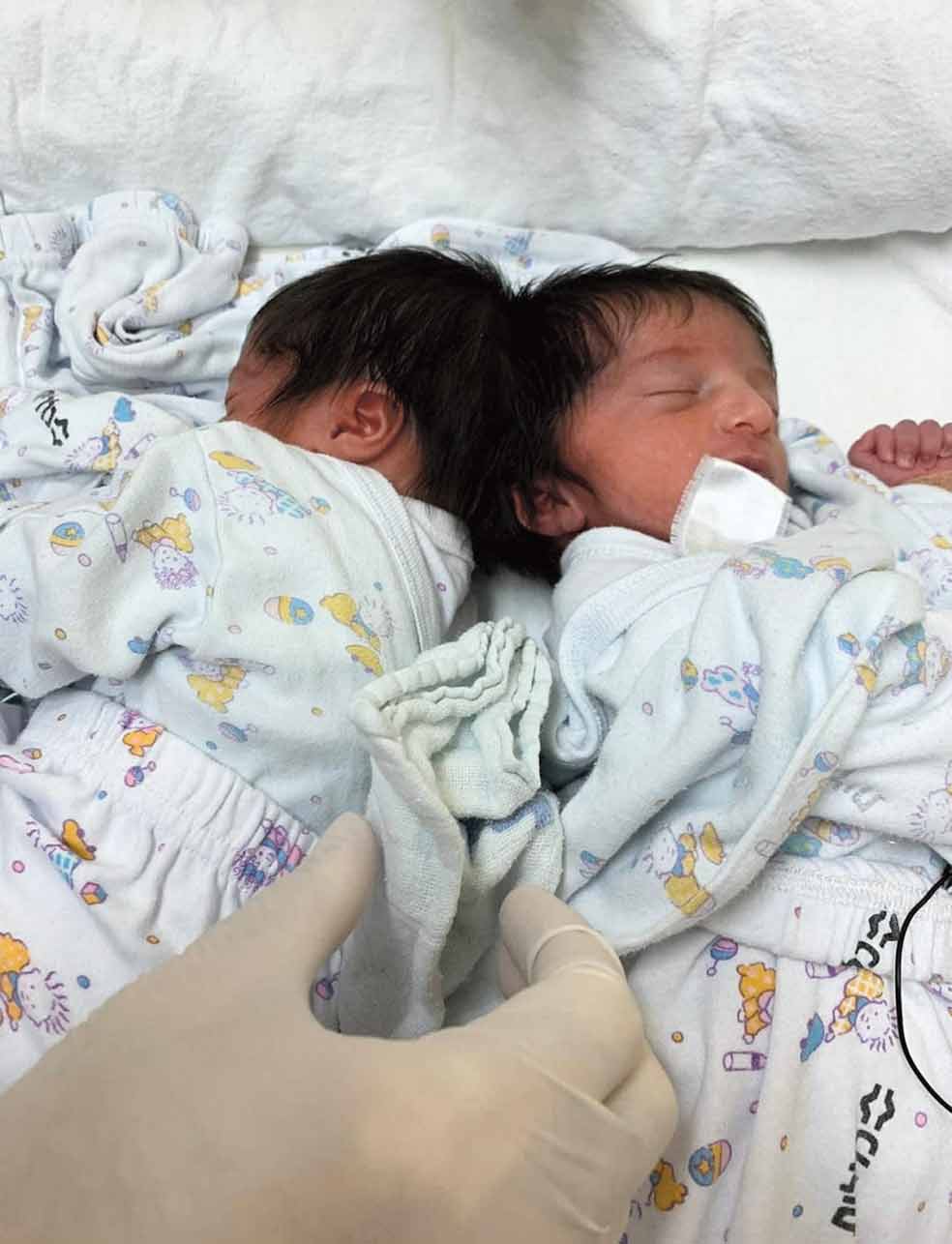 Las gemelas siamesas israelíes nacieron unidas por la cabeza. El proceso de su separación, que comenzó desde el momento de su nacimiento y tuvo lugar cuando tenían un año, ha marcado la historia de la medicina en Israel.