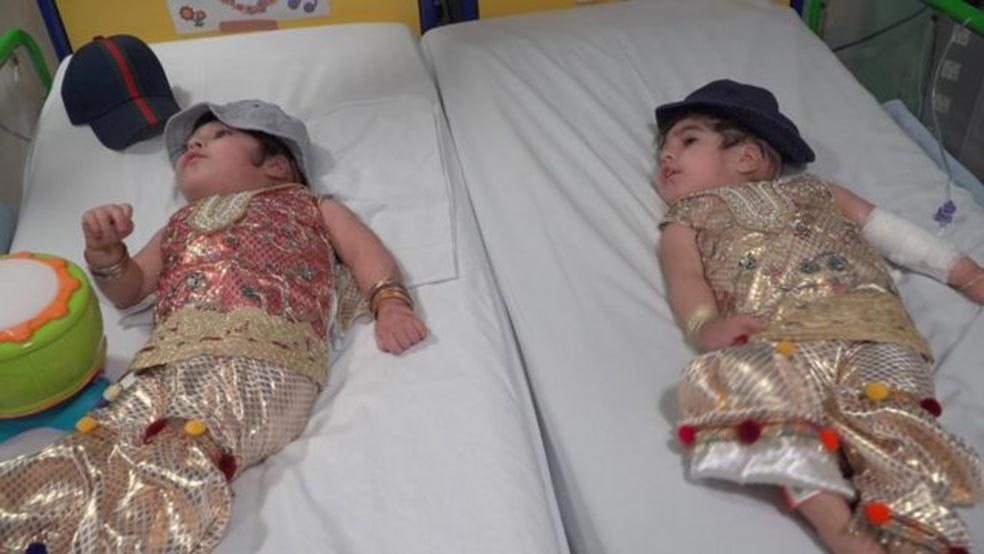 Las gemelas siamesas pakistaníes Safa y Marwa, ya separadas, en sus respectivas cunas, tras la intervención. Durante los cinco meses posteriores y, antes de salir del hospital como personas independientes, recibieron fisioterapia para aprender nociones básicas como mantener la cabeza erguida o sentarse.
