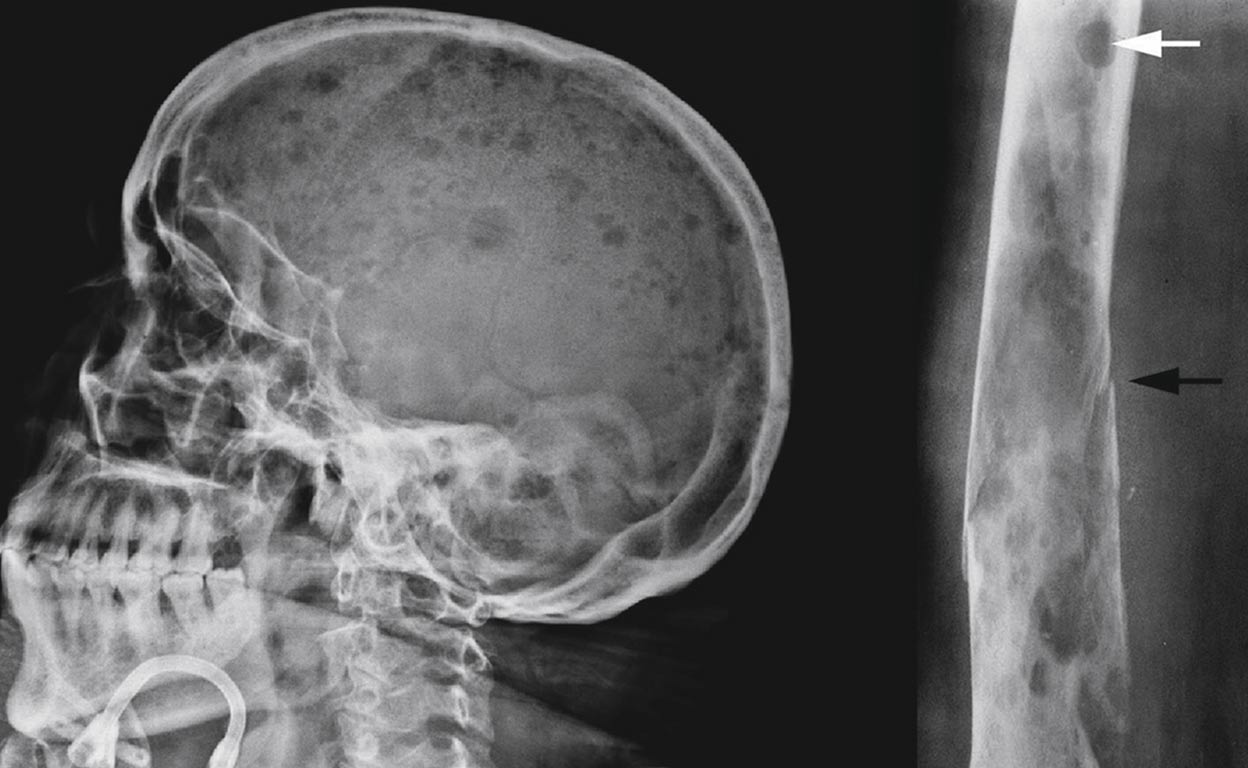 Mieloma múltiple, el cáncer invisible