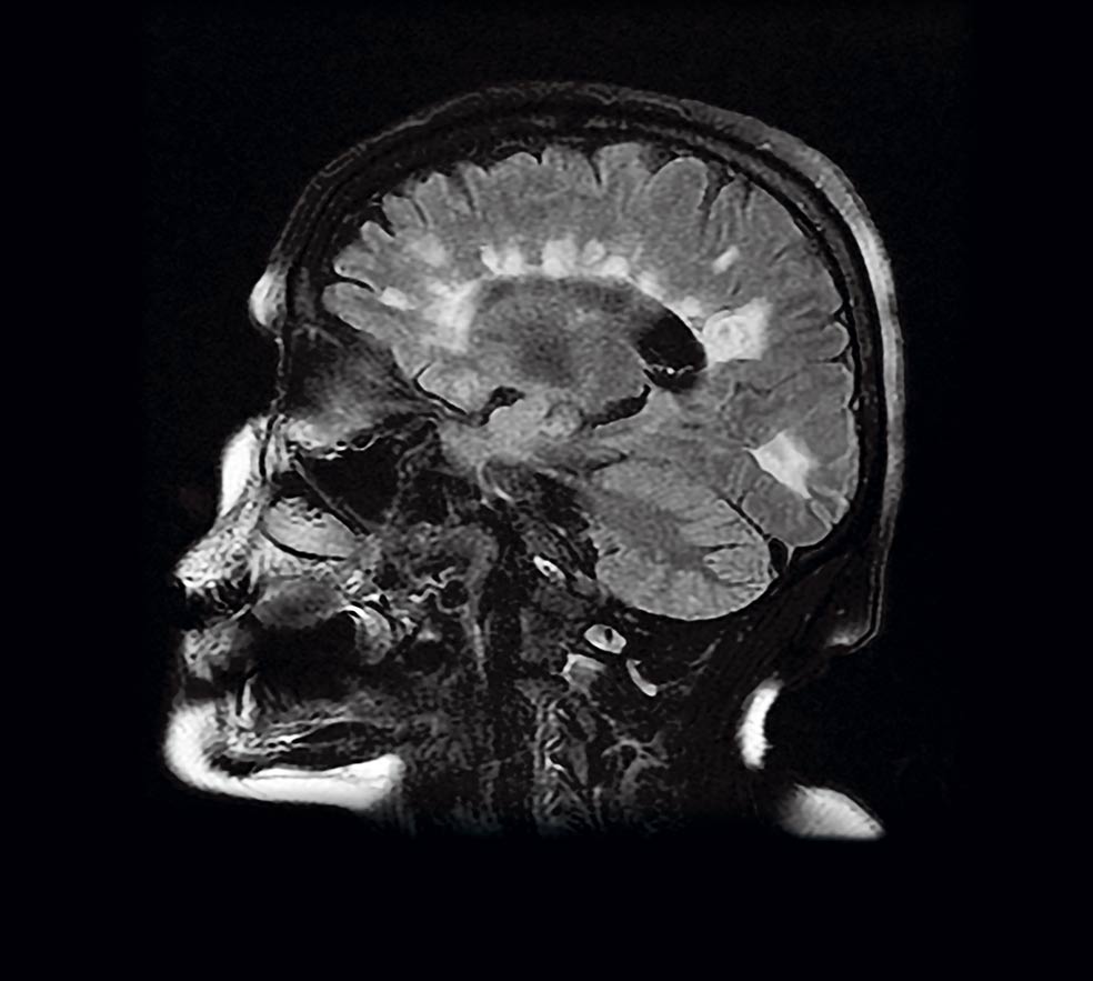 La resonancia magnética es una de las pruebas que se utilizan para observar si hay lesiones compatibles con la esclerosis múltiple. Se conocen como 'placas' y son las manchas blancas que aparecen en la imagen.