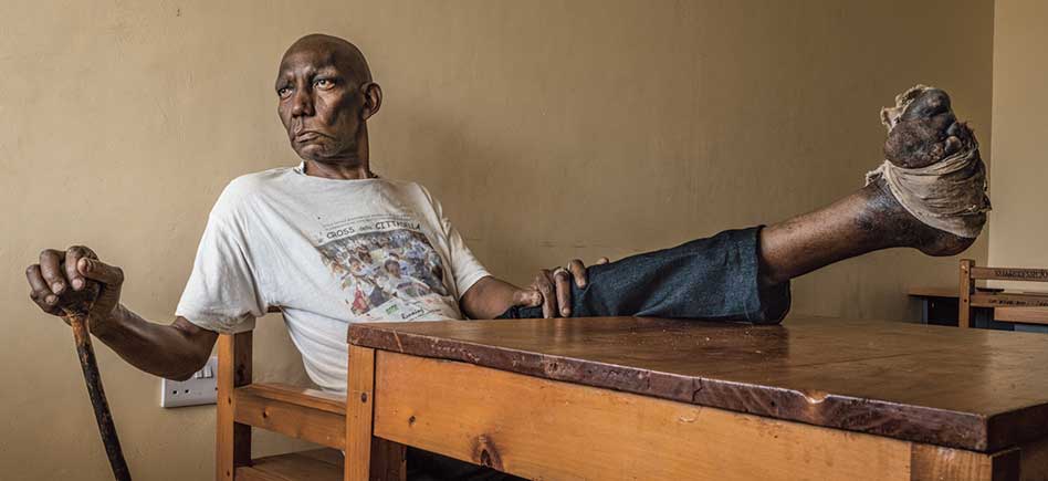 Abdul Juma Haridi, de Chamwino (Tanzania), perdió varios dedos del pie tras ser atacado por una rata mientras dormía. La herida se gangrenó y tuvieron que amputarle las falanges. Tiene 58 años, es padre de tres hijos y ha perdido su trabajo como fontanero. «Sufro dolores constantes», explica.