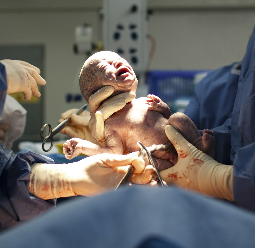 Imagen - EN EL PARTOLos primeros microbios 'buenos' los adquiere el bebé durante el parto a través de la propia vagina de su madre. Los bebés nacidos por cesárea tienen más alergias, asmas y problemas autoinmunes. Algunos investigadores proponen usar una torunda de algodón estéril para empapar a estos recién nacidos con secreciones vaginales maternas.