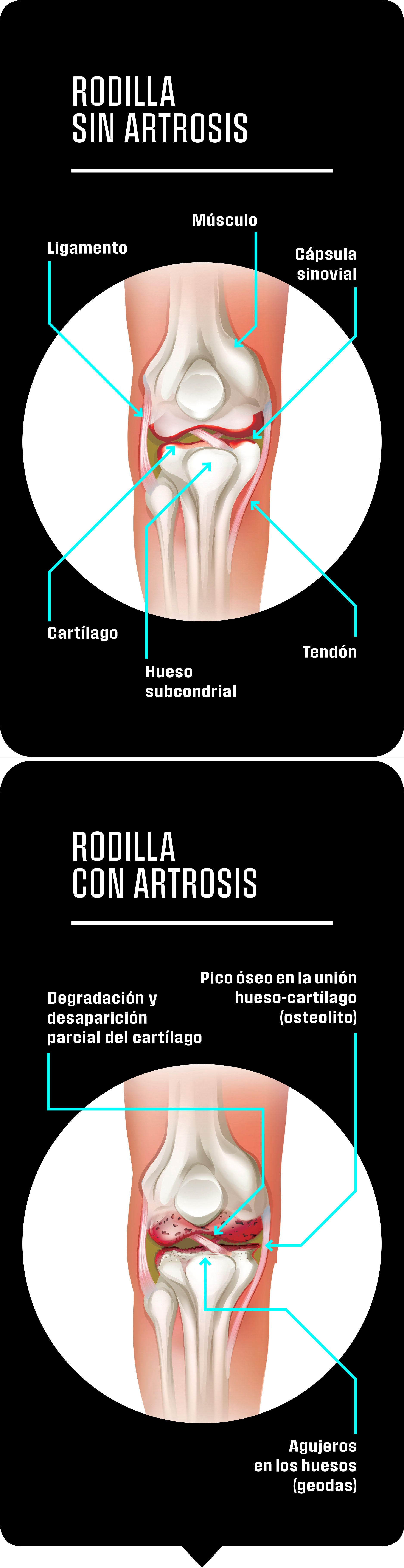 El cartílago permite que las piezas de la articulación tengan poco rozamiento entre sí. Cada vez más traumatólogos apuestan por el poder curativo del movimiento. Se cree que una actividad constante favorece la presencia de células madre en la zona, lo que podría regenerar el cartílago.