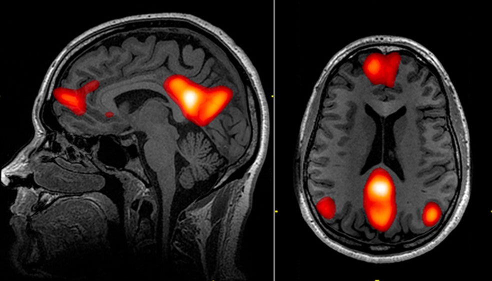 La red neuronal por defecto es el conjunto de regiones del cerebro que se activan cuando el cerebro está en reposo o divaga. Antes de la tecnología RMf, que permite detectar este tipo de actividad, se creía que la actividad del cerebro disminuía radicalmente cuando se producía ese proceso. Ahora se sabe que se trata tanto de un 'ahorro energético' como de una conexión neuronal distinta.
