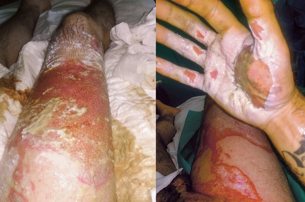 La explosión de la batería de un cigarrillo electrónico provocó a Raúl quemaduras de segundo y tercer grado en una pierna, desde la rodilla hasta el estómago, y en la mano al intentar apagarlo.