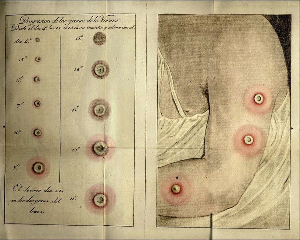 El médico español Francisco Javier Balmis tuvo la idea de transportar la vacuna inyectada en niños. Del pus varioloso de sus granos tomaba muestras para el siguiente niño. Así salvó millones de vidas.