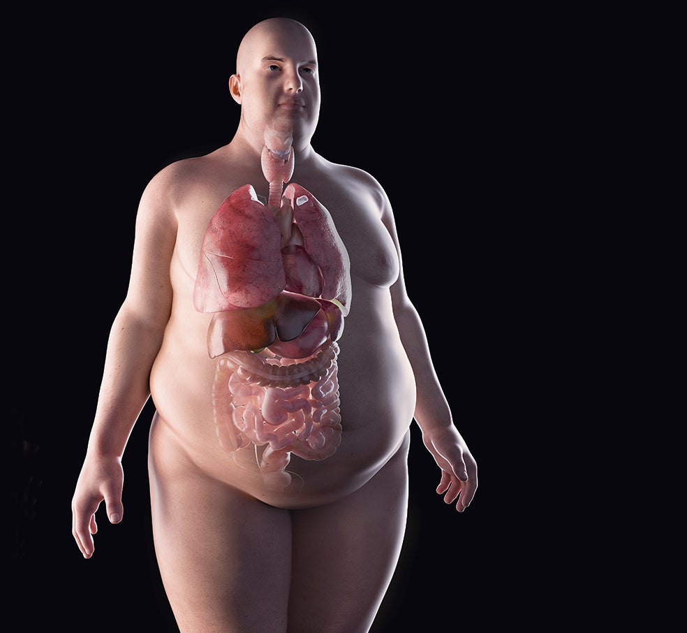 Tiene distintos grados. Cuando sus síntomas son leves, pasan inadvertidos y el paciente tarda en acudir al médico. No suele surgir de forma abrupta, sino que es un proceso paulatino: metabolismo ralentizado, aumento de peso, sensación de frío, estreñimiento, párpados hinchados, cansancio y pérdida de cabello. De hecho, un nivel muy elevado de colesterol o una anemia repentina pueden hacernos sospechar que se sufre hipotiroidismo.