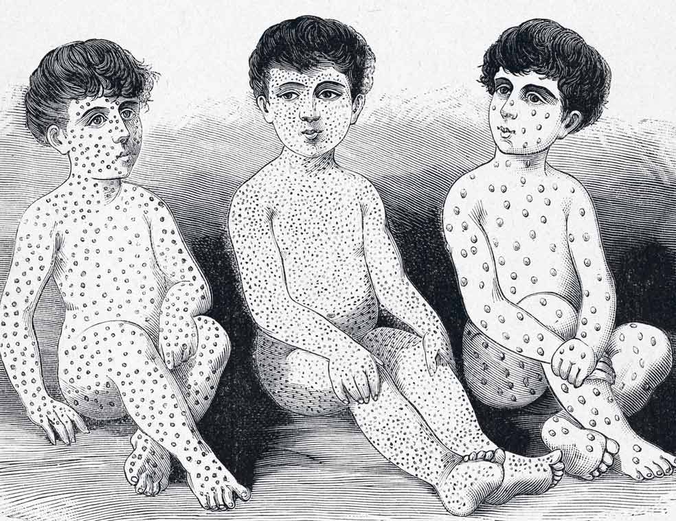 Ilustración de la época que instruye sobre los diferentes tipos de pústulas de las enfermedades a las que iban asociadas más frecuentes en la época: varicela, escarlatina y viruela.