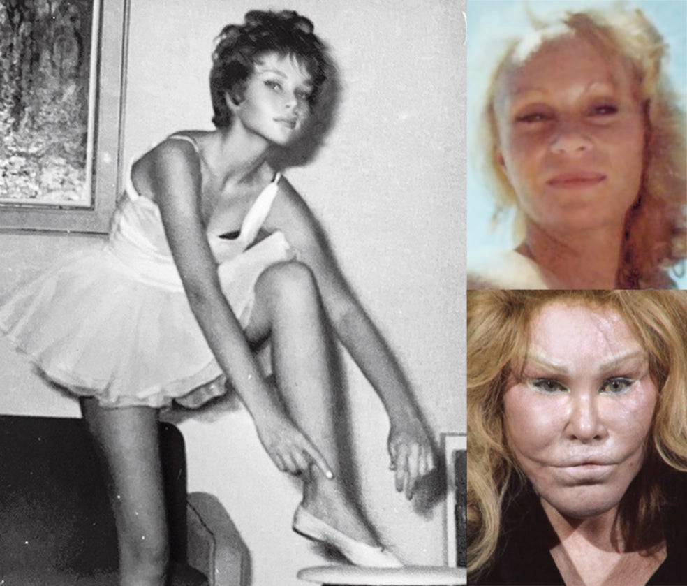 No es fácil encontrar fotos de Wildenstein antes de comenzar su 'épica' intervención facial. Ella misma colgó en las redes una foto de cuando era adolescente, vestida de bailarina, pero con la cara claramente retocada. Pretendía demostrar que no se había operado tanto y que ya de pequeña tenía un rostro felino. La única foto que parece real de ella antes de la cirugía (fue publicada por una prestigiosa revista hace años) la muestra ya en su treintena, sin maquillar (derecha). Y la imagen más terrible es la del registro policial tras la agresión a su marido en 2017, que fue 'implacable'.