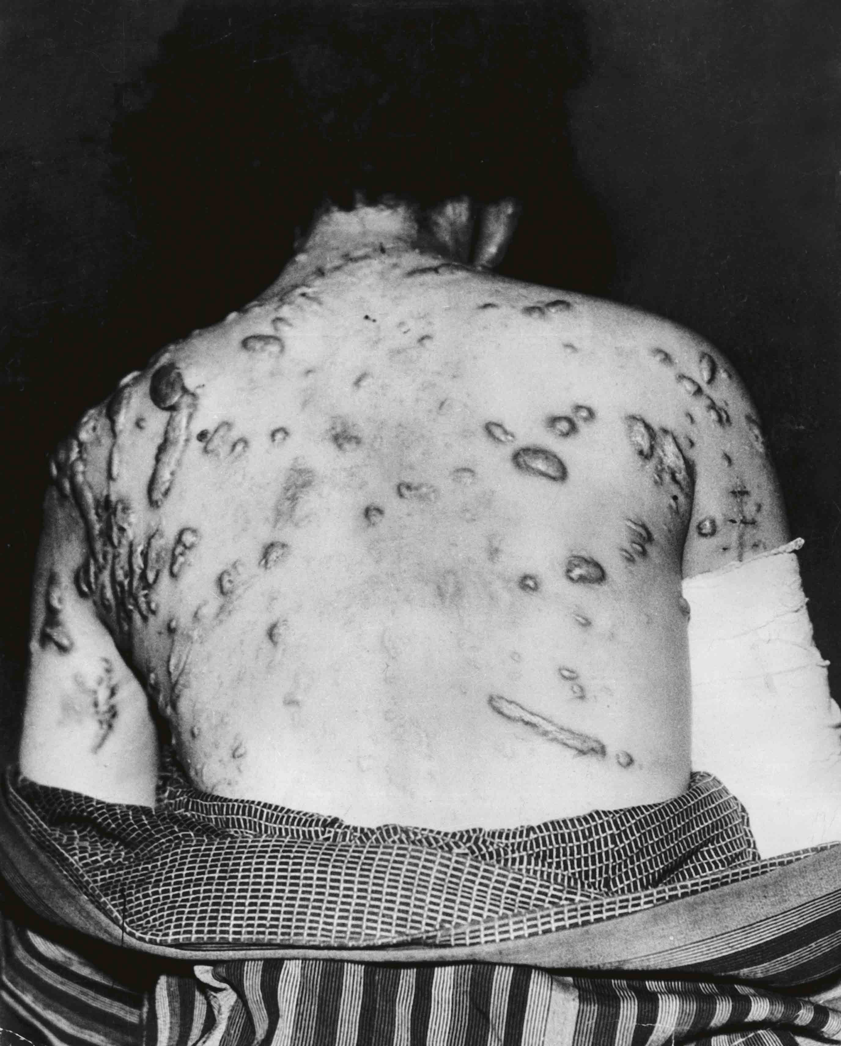 Los estampados de la ropa llegaron a grabarse de por vida en los cuerpos de algunos supervivientes.