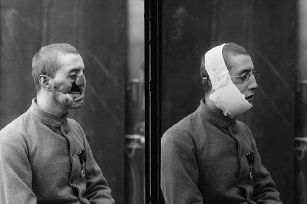 Las numerosas esquirlas metálicas que, durante la Primera Guerra Mundial, las bombas desprendían al explotar causaron, además de cientos de miles de muertes, las más traumáticas heridas faciales. La reconstrucción de un rostro en esos años se volvió por ello una imperiosa necesidad, que sólo se convirtió en parte integral del proceso de recuperación de las personas tras el descubrimiento de los antibióticos. Antes, someterse a una cirugía reconstructiva podía ser tan riesgoso como encontrarse cerca de una detonación.