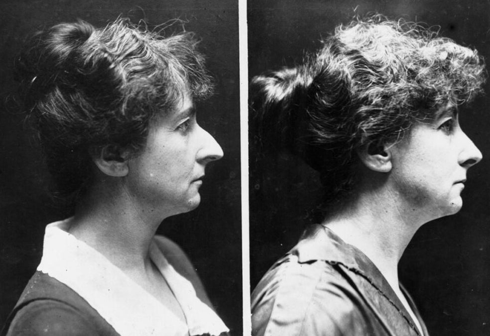 Jakob Joseph era un joven cirujano judío que a finales del siglo XIX cambió su nombre por el de Jacques Joseph para disimular su origen. Joseph comenzó operando en Berlín 'orejas judías' (tipo murciélago) para aliviar complejos y desarrolló un método que modificaba la típica nariz semítica. Germanizando el rostro, sus congéneres podían pasar inadvertidos en los inicios del movimiento político antisemita.