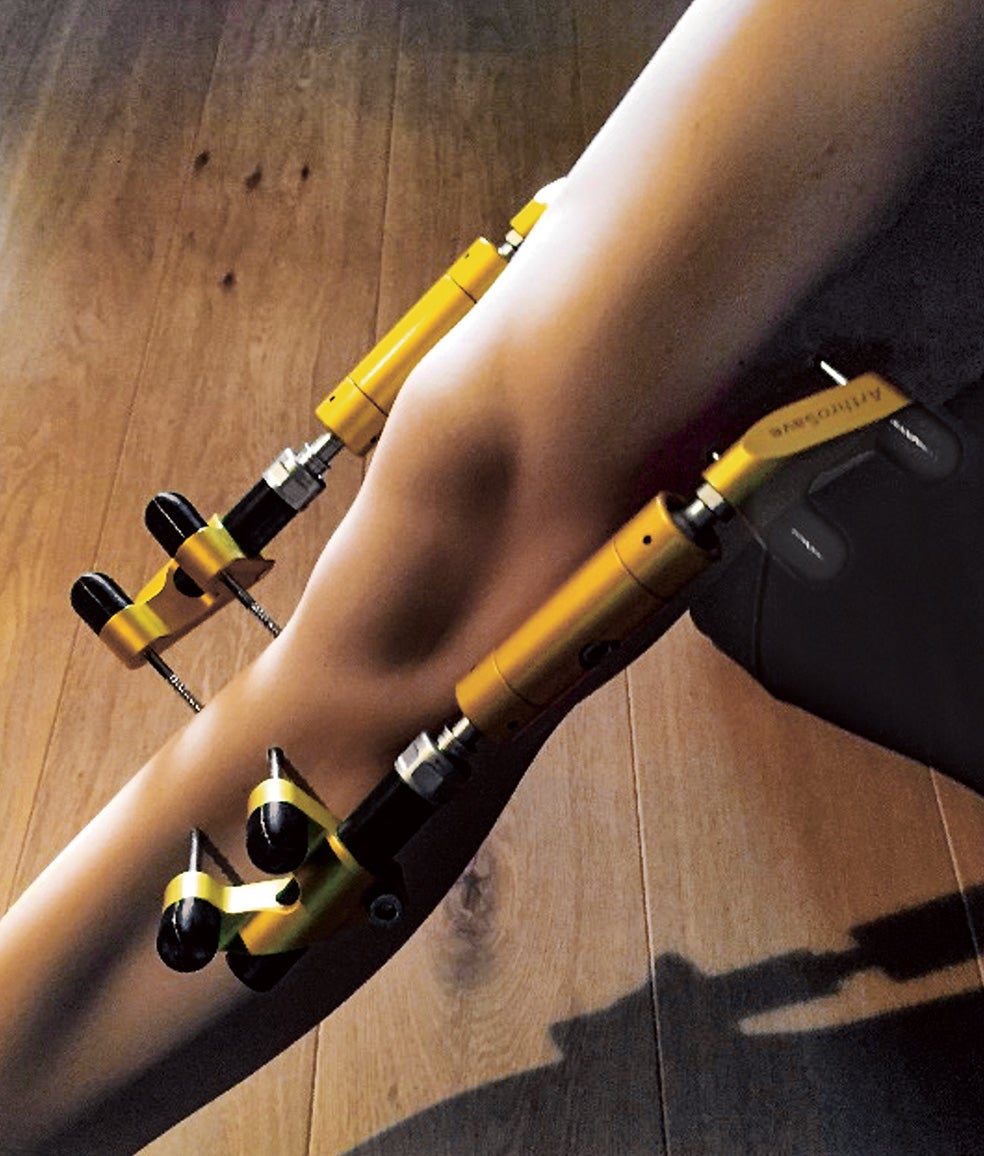 Al disminuir el cartílago se produce el doloroso roce entre huesos. En la Universidad de Utrecht dicen que han hallado un remedio para regenerarlo mediante distracción articular (estiramiento), realizada con un armazón especial.