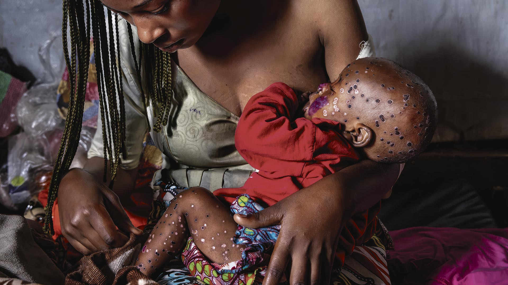 La inesperada víctima de la viruela del mono en el Congo: los niños