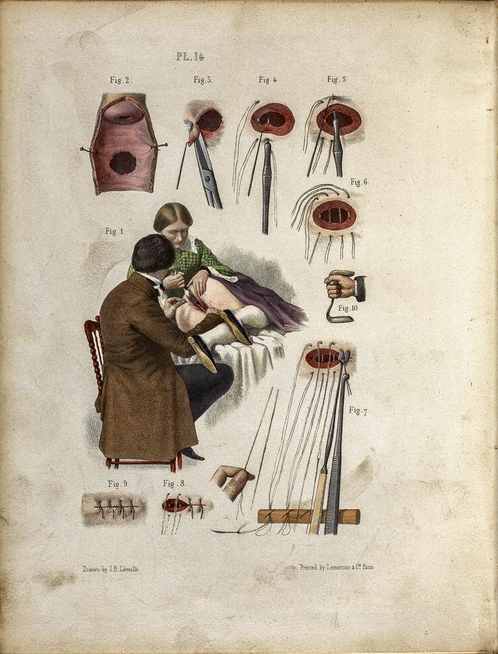 James Marion Sims colocaba a sus pacientes de modo que la exploración de la vagina fuera más accesible. Se llama 'postura Sims'. Aquí, ilustración de 1862 de su método para curar fístulas vesicovaginales. Probó varias técnicas (en esclavas y sin anestesia) durante años. La clave final del éxito (en 1849) fue usar alambre de plata para las suturas.