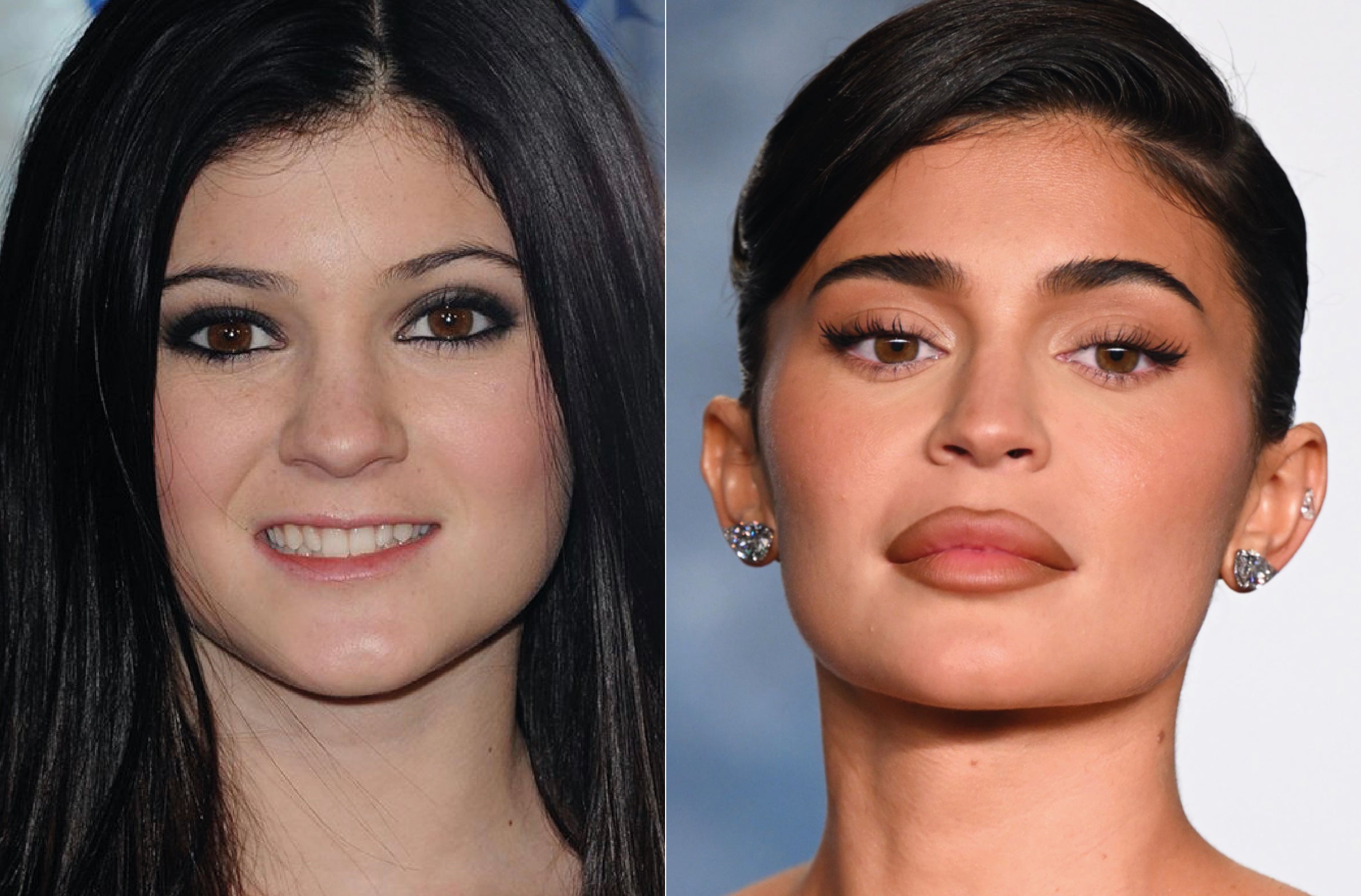 La pequeña de las Kardashian lleva pasando por el quirófano de Simon Ourian, el cirujano de las estrellas, desde sus 17 años. Según el médico, Kylie se ha sometido a un aumento de glúteos, perfilado de barbilla, rinoplastia, la forma de los ojos, moldeado de caderas y relleno de labios.
