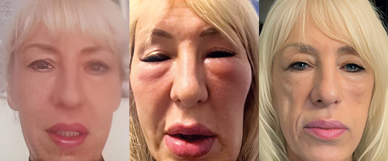 «Vivo una pesadilla todos los días», asegura Andrea, una mujer británica de 60 años que ha visto como su cara se desfiguraba tras ponerse en manos de un tatuador que se hacía pasar por médico en Yorkshire (Inglaterra). Según una investigación de la BBC, la mujer sufrió una infección tras un relleno facial de ácido hialurónico y, a pesar de vender joyas y pedir prestado para pagar los tratamientos, la reacción empeoró y tuvo que acabar yendo a urgencias.