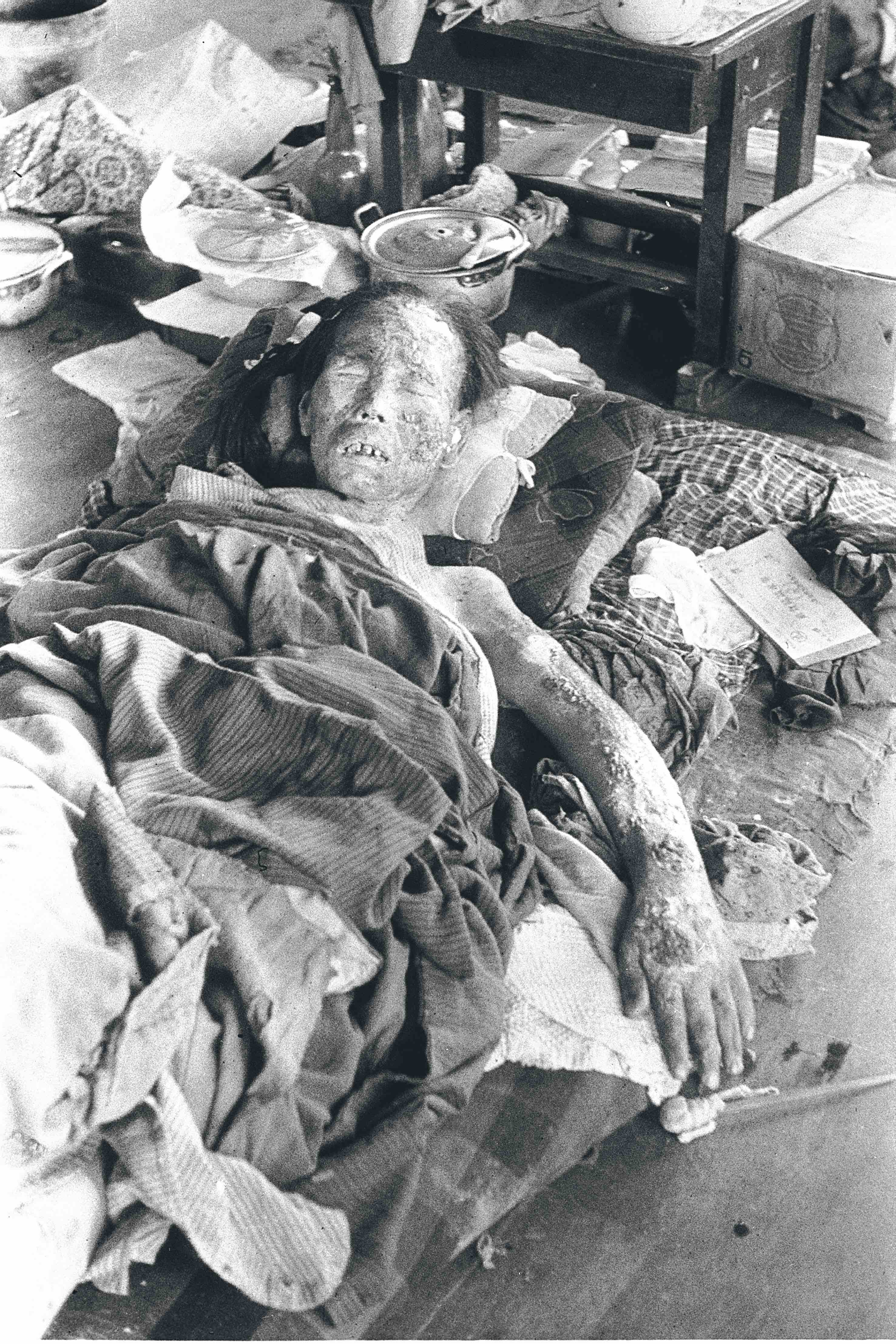 Antes de llegar a Hiroshima, Eiichi Matsumoto documentó el horror en Nagasaki. Allí inmortalizó a este superviviente con la piel carbonizada en una escuela convertida en hospital. La magnitud de la catástrofe obligó a transformar colegios y templos en centros médicos de emergencia.