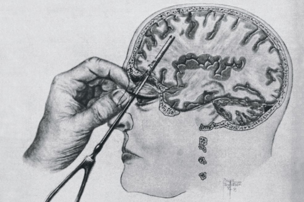 La ilustración detalla el procedimiento habitual de la lobotomía, que alcanzaba los lóbulos prefrontales a través del ojo.